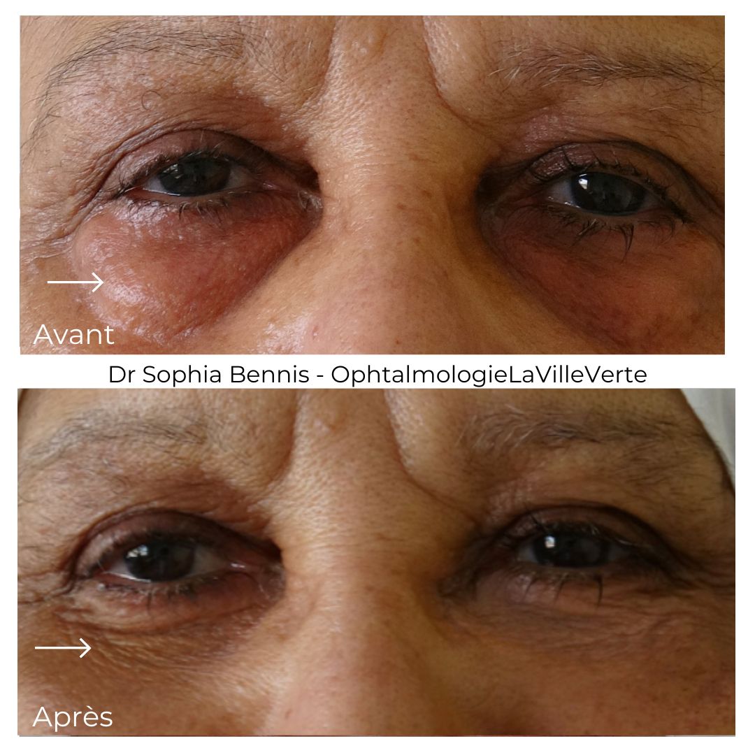 Avant / après : Blépharoplastie inférieure
