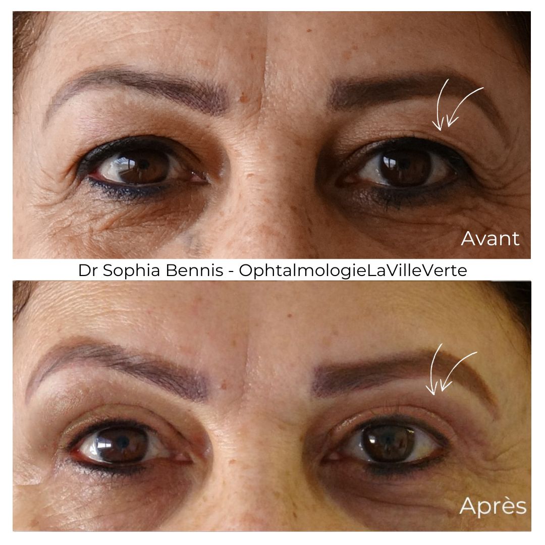 Résultat avant / après en oculoplastie