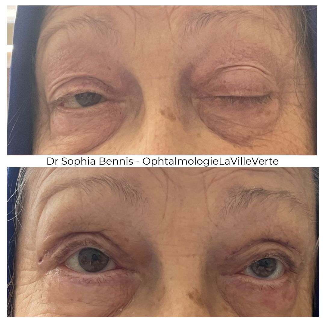 Avant / après : Chirurgie de ptosis complexe