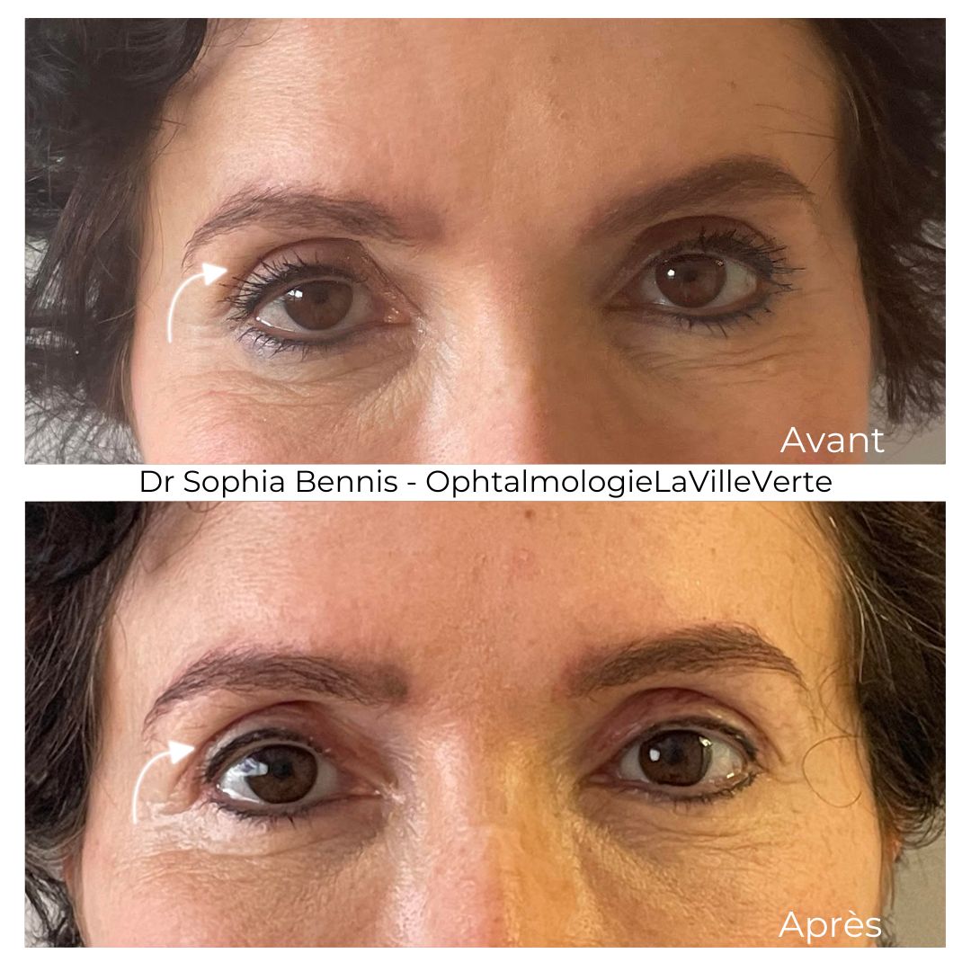 Avant / après : Chirurgie de ptosis