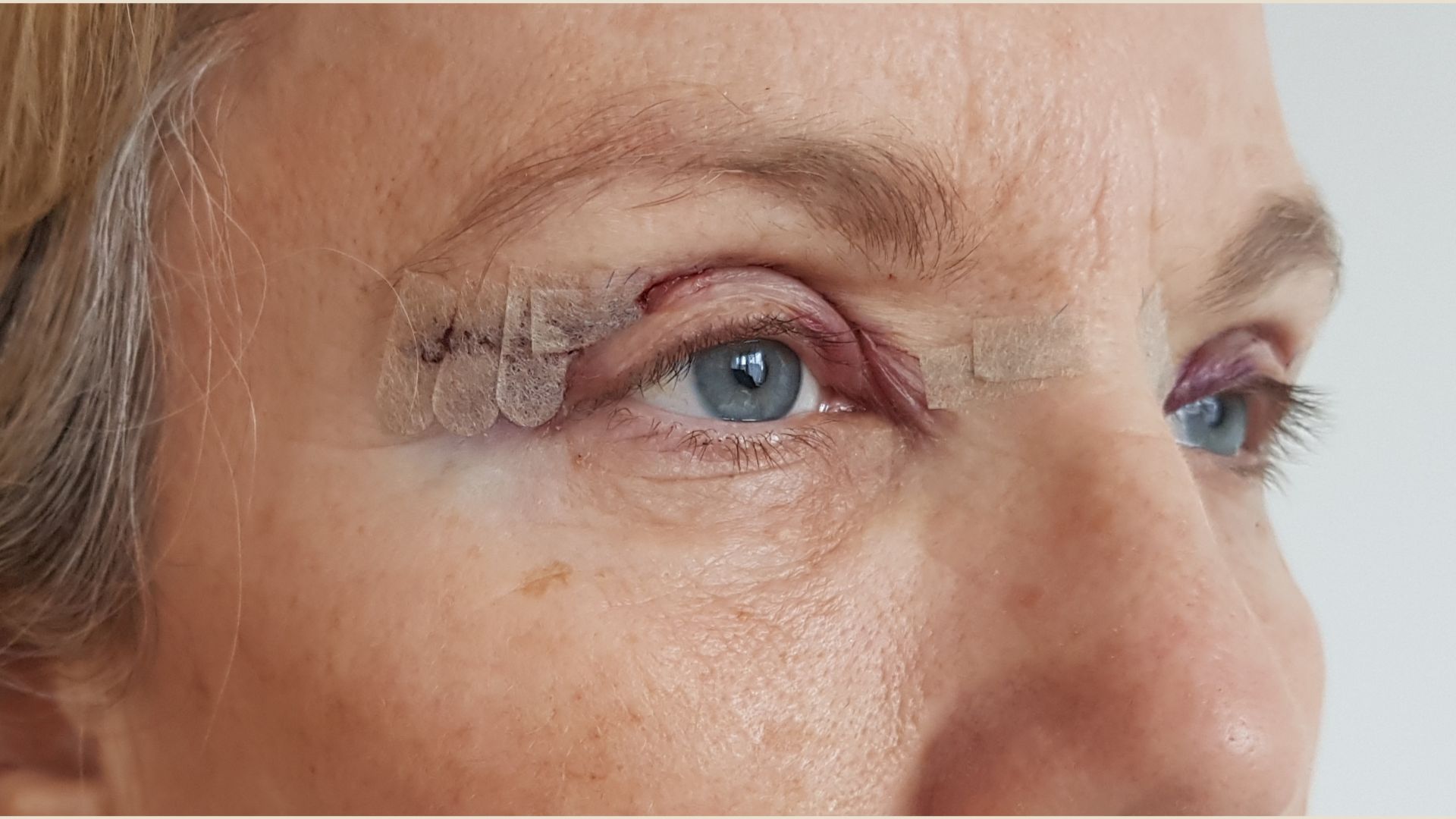 Blépharoplastie supérieure