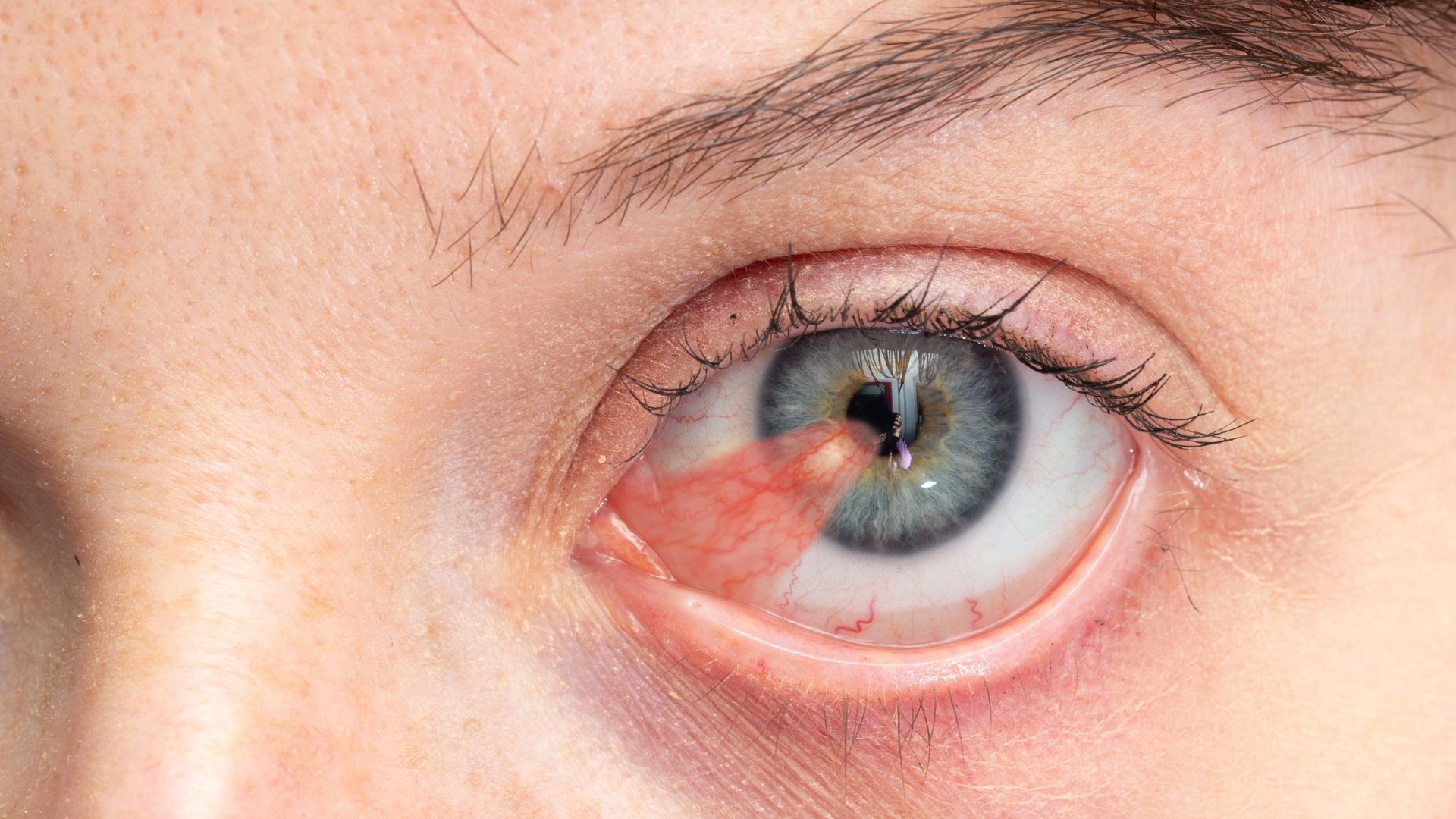 Chirurgie du ptérygion